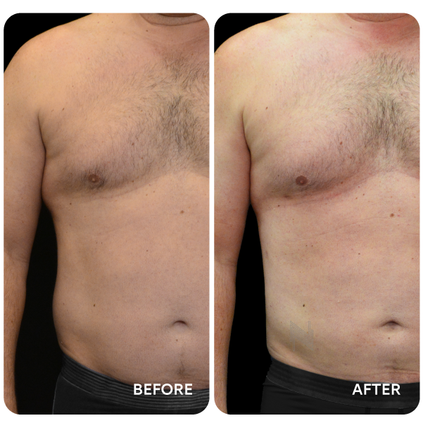 شفط دهون البطن