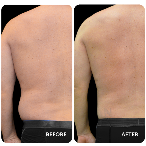 شفط دهون البطن