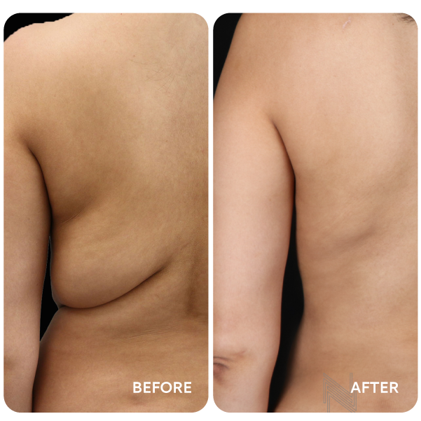 شفط دهون البطن