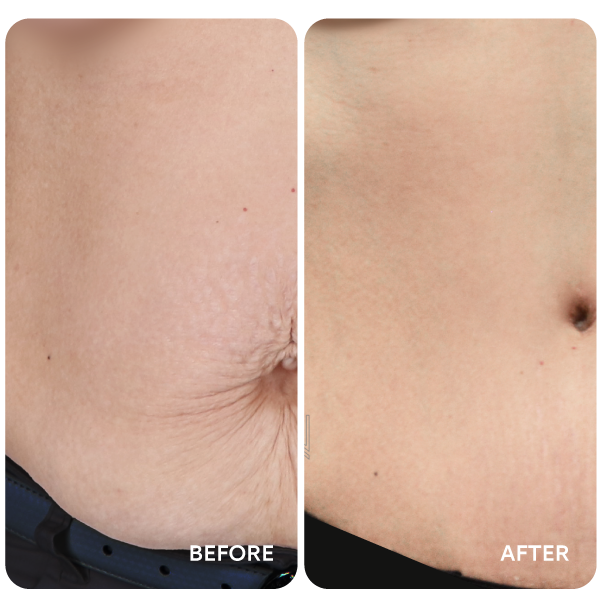 شفط دهون البطن