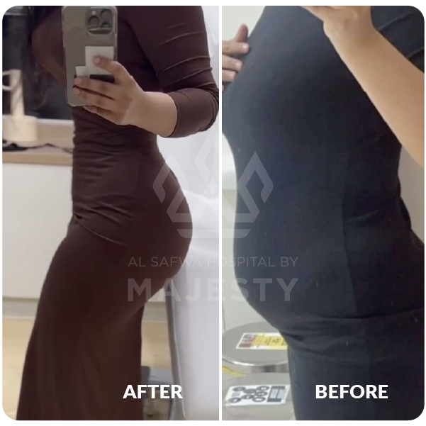 شفط وشد البطن