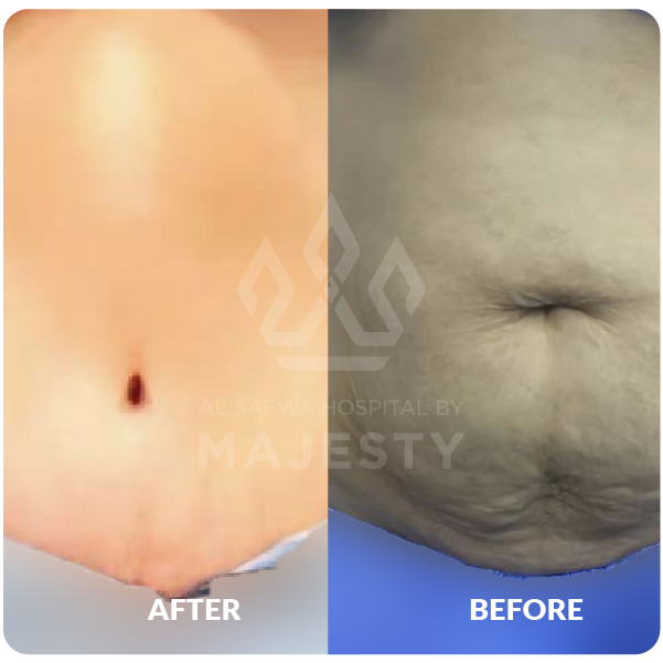 شفط وشد البطن