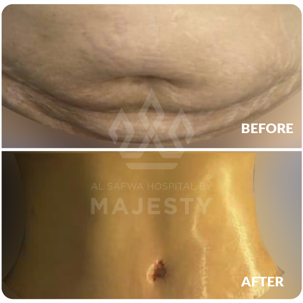 شفط وشد البطن