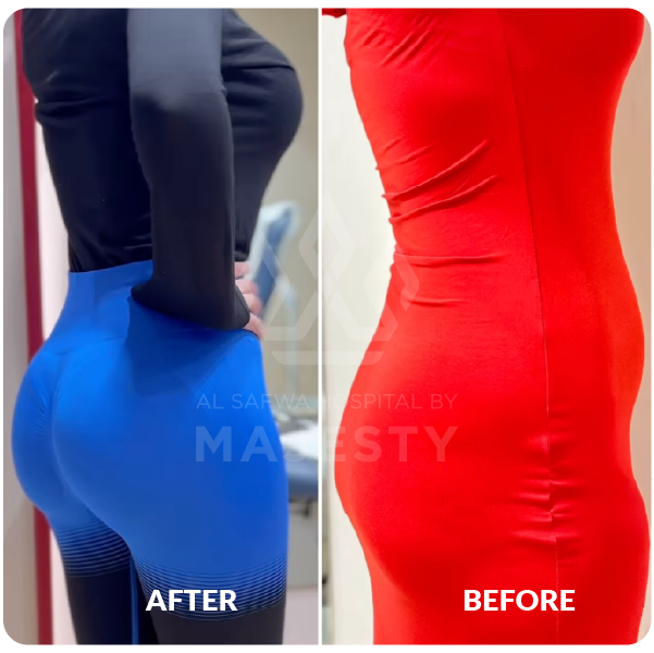 شفط وشد البطن