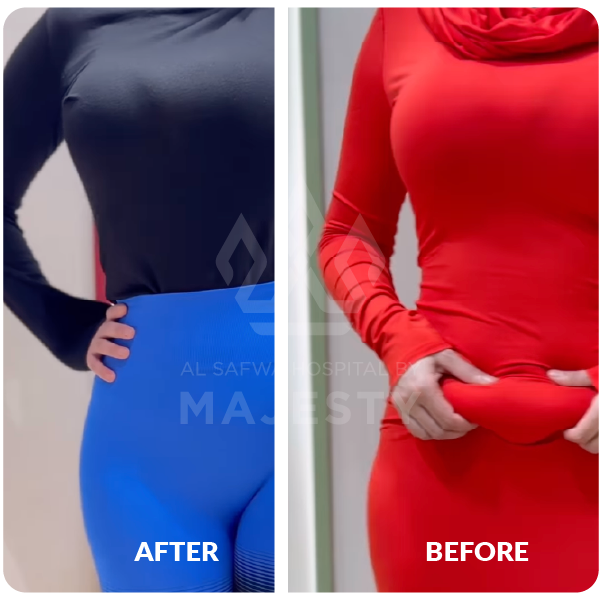 شفط وشد البطن