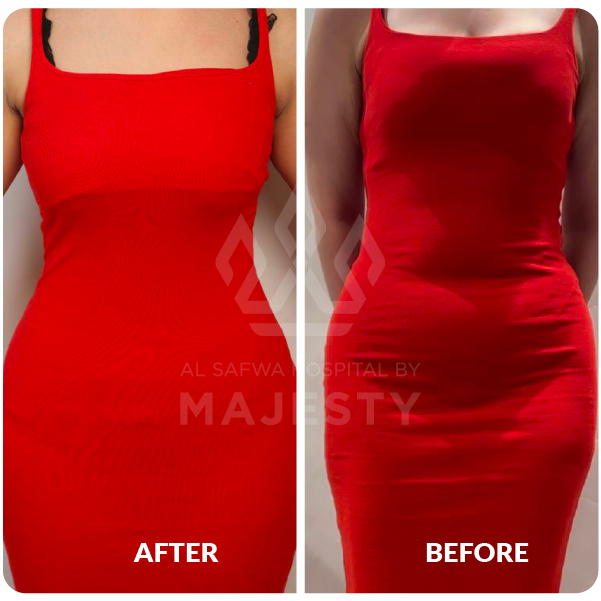 ِشفط دهون البطن