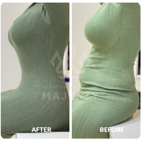 شفط دهون البطن