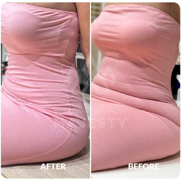 ِشفط دهون البطن