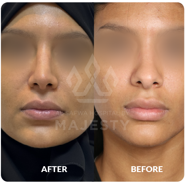 تجميل الأنف