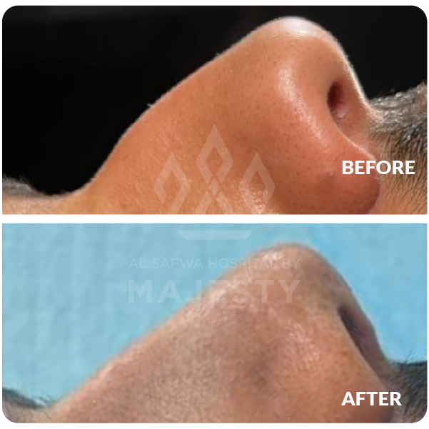 عملية تجميل الأنف