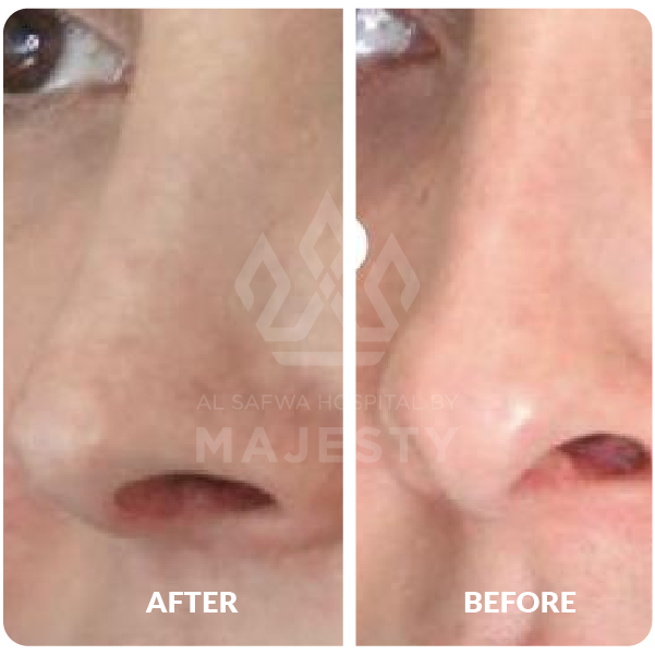 تجميل الأنف