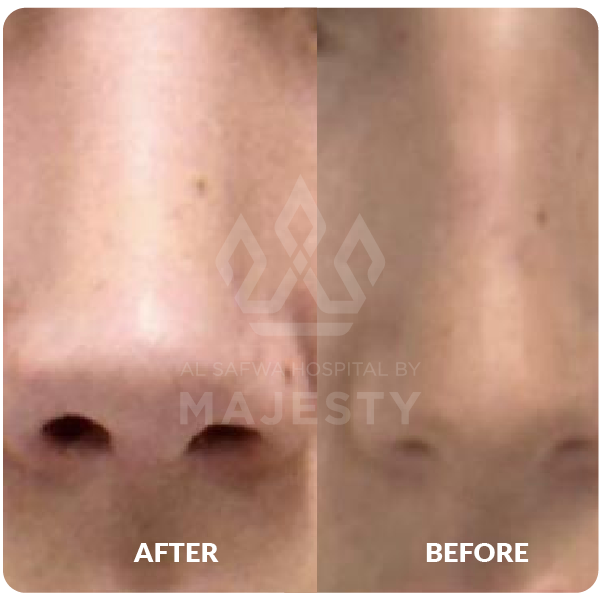 تجميل الأنف