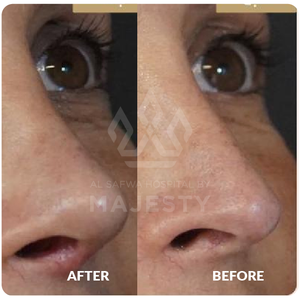 تجميل الأنف