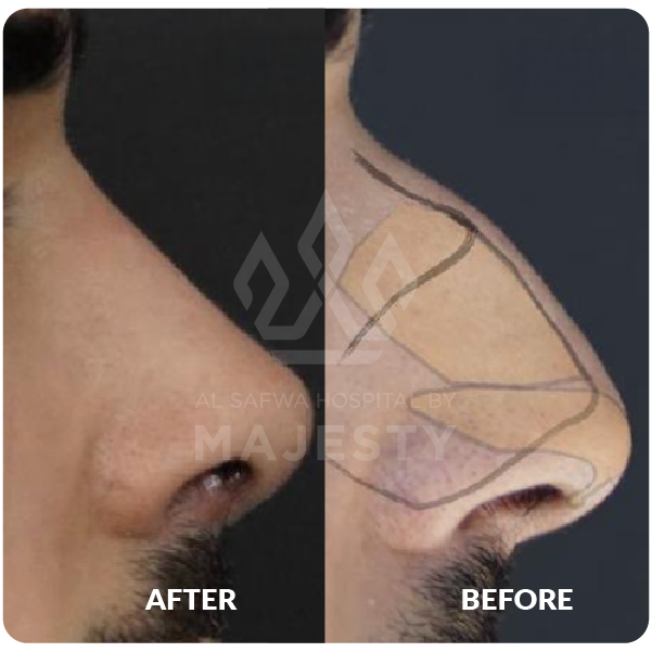 عملية تجميل الأنف_14