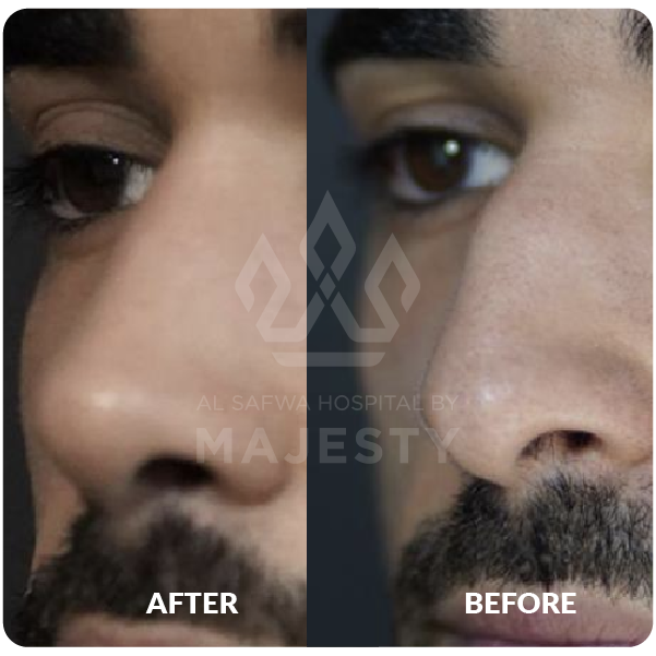 تجميل الأنف