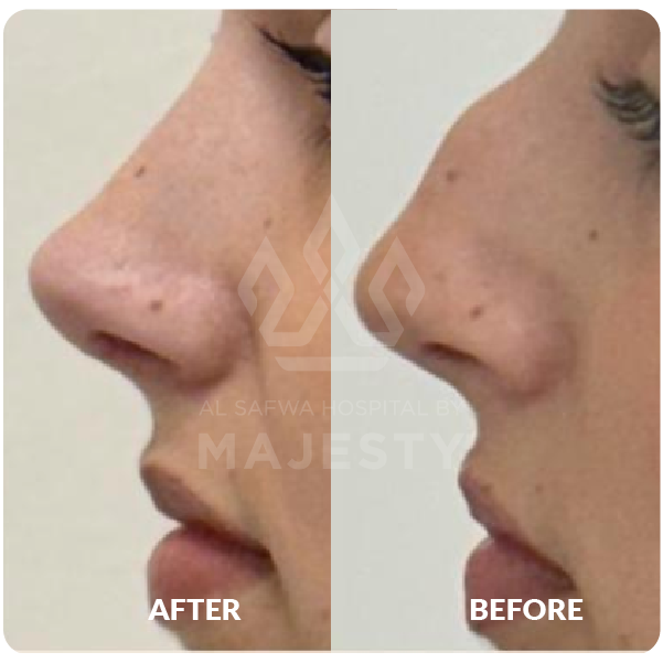 تجميل الأنف