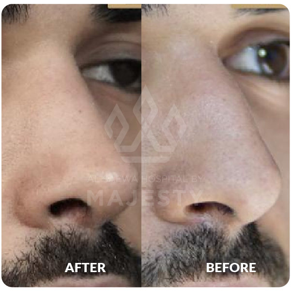 تجميل الأنف