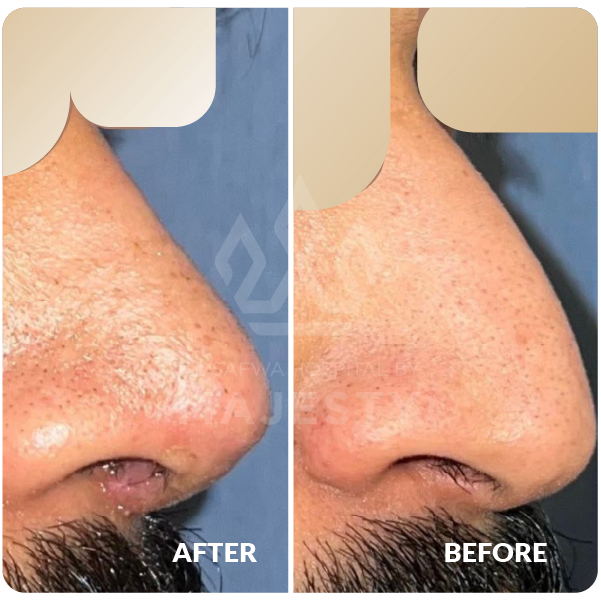 عملية تجميل الأنف