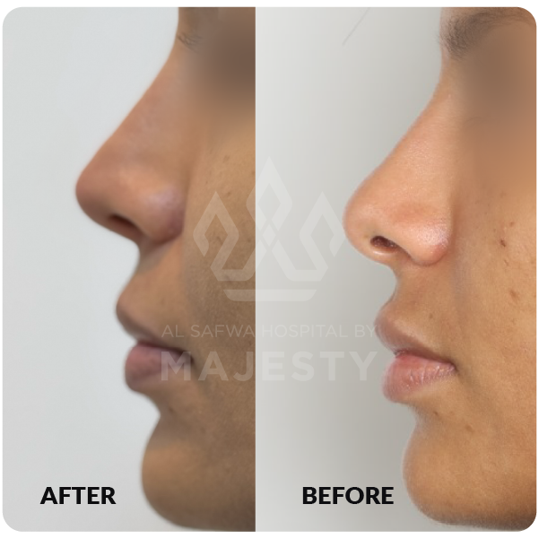 تجميل الأنف