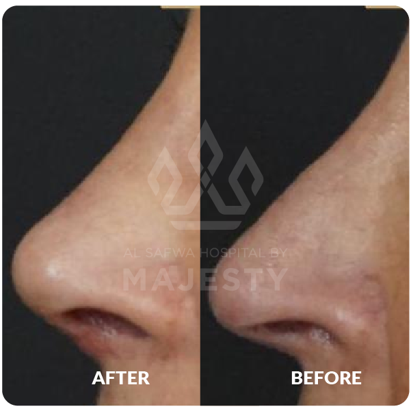 تجميل الأنف