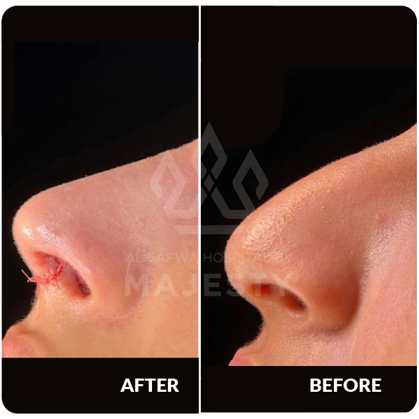 عملية تجميل الأنف