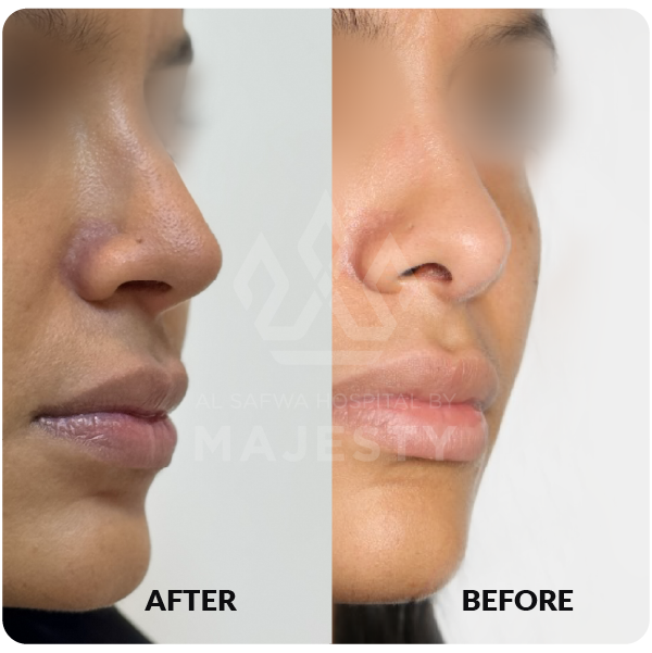 Rhinoplasty