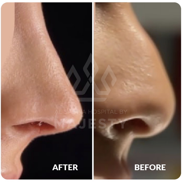 عملية تجميل الأنف