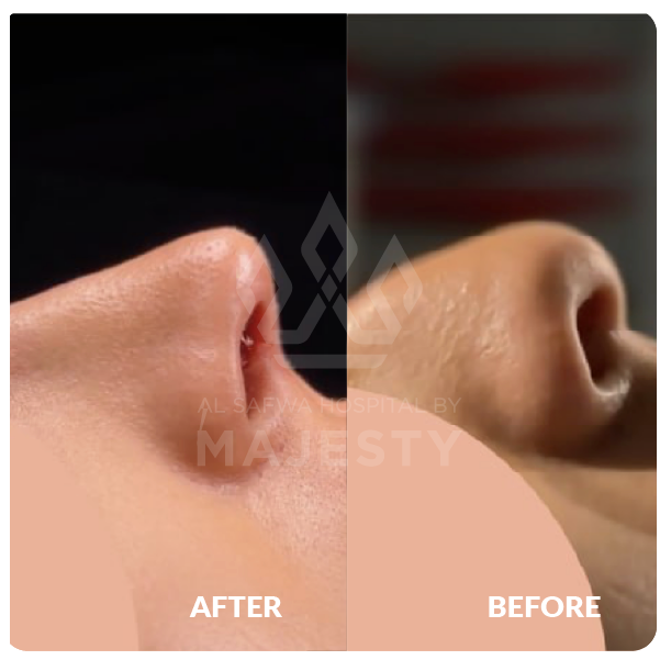 عملية تجميل الأنف