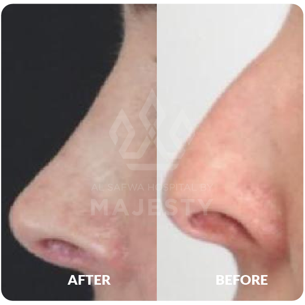 تجميل الأنف