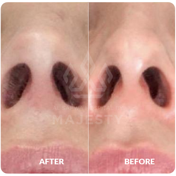 تجميل الأنف