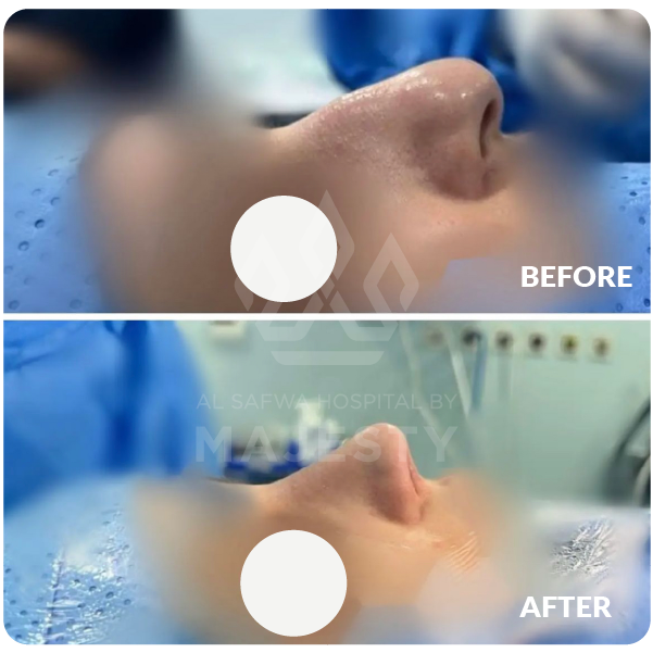 تجميل الأنف