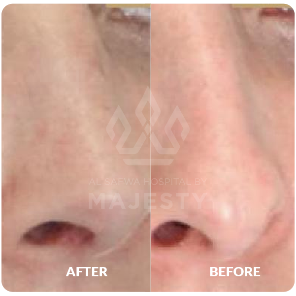 تجميل الأنف