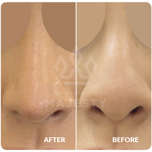 عملية تجميل الأنف
