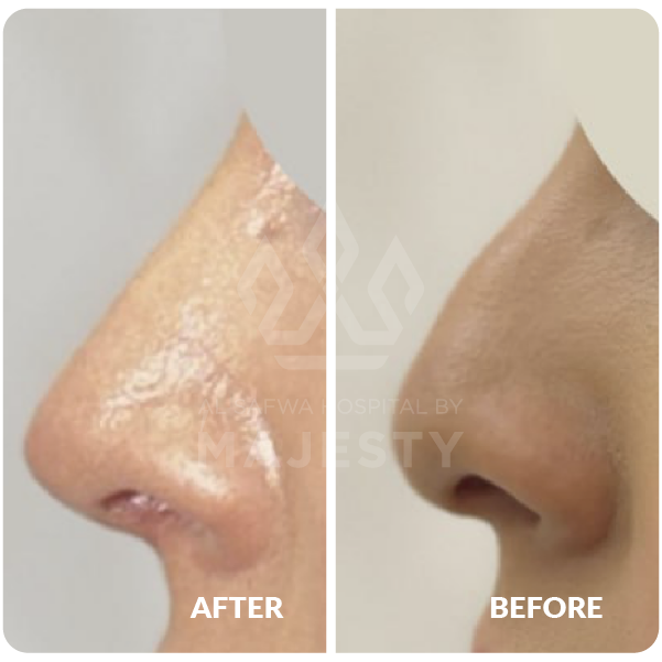 عملية تجميل الأنف