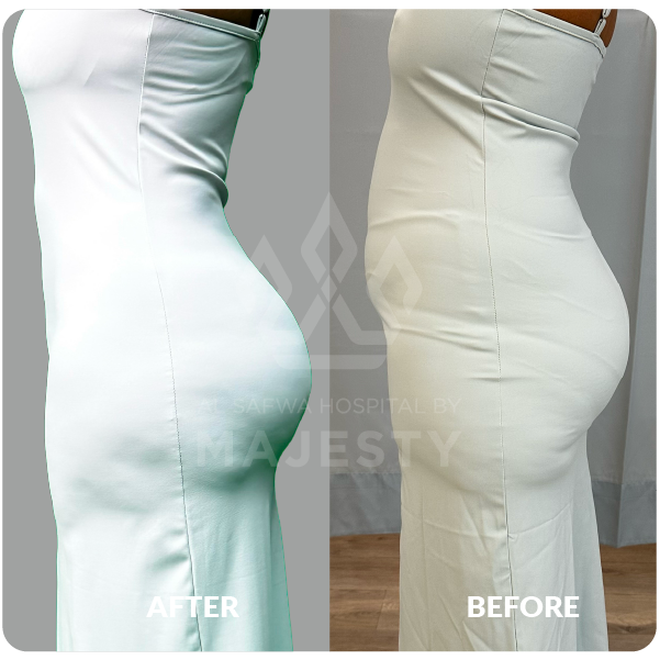 شد وشفط البطن مع الحقن البرازيلي