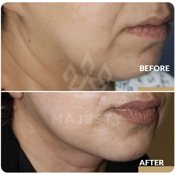 شد الوجه والرقبة