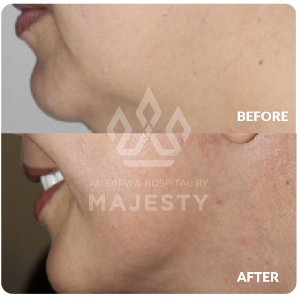 شد الوجه والرقبة