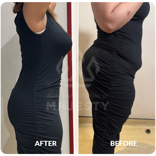 شد حزامي 360 مع حقن المؤخرة