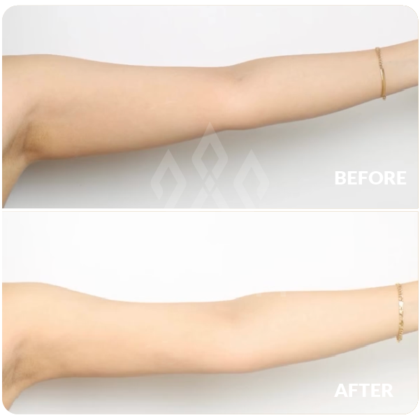 شد الذراعين