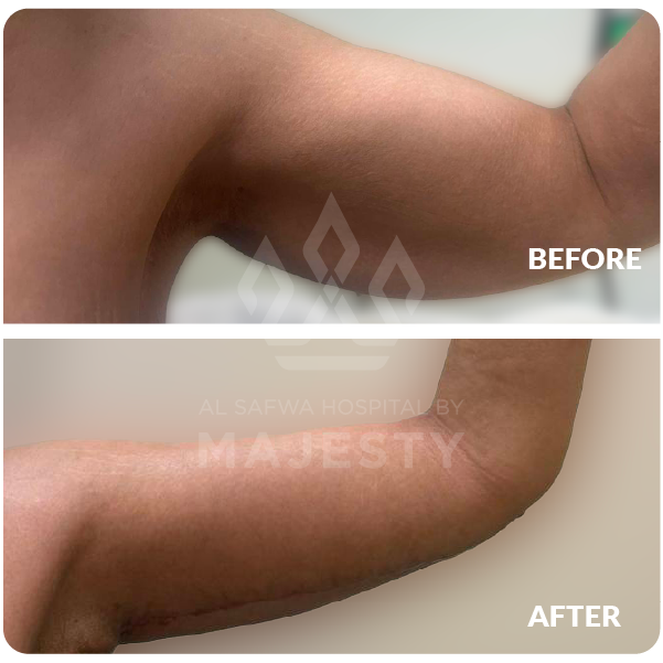 شد الذراعين