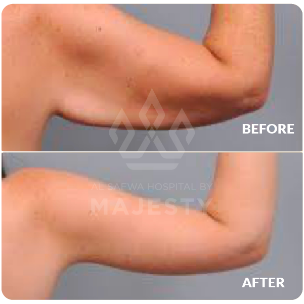 شد الذراعين