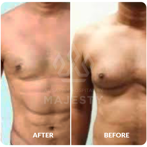 Body sculpting and muscle definition