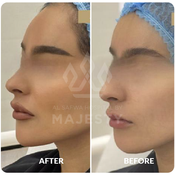 فيلر الشفايف وتحديد الذقن