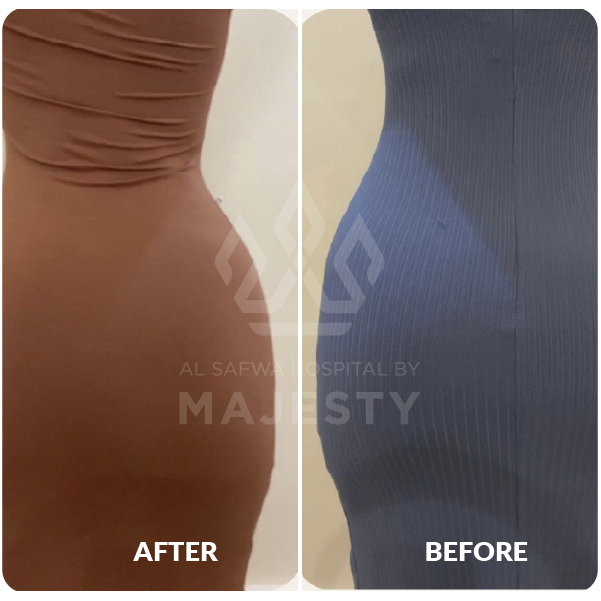 نحت الجسم وحقن المؤخرة البرازيلي