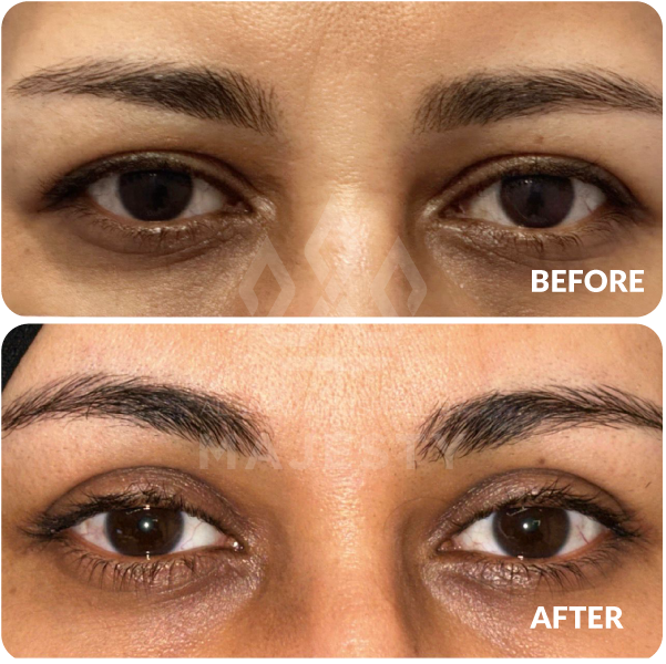 تجميل الجفون