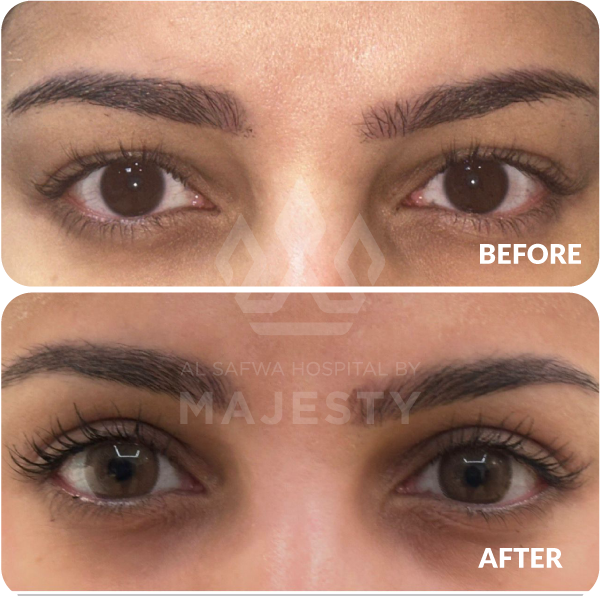 تجميل الجفون