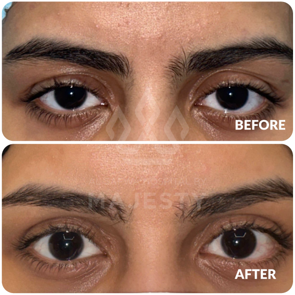 تجميل الجفون