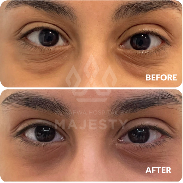 تجميل الجفون