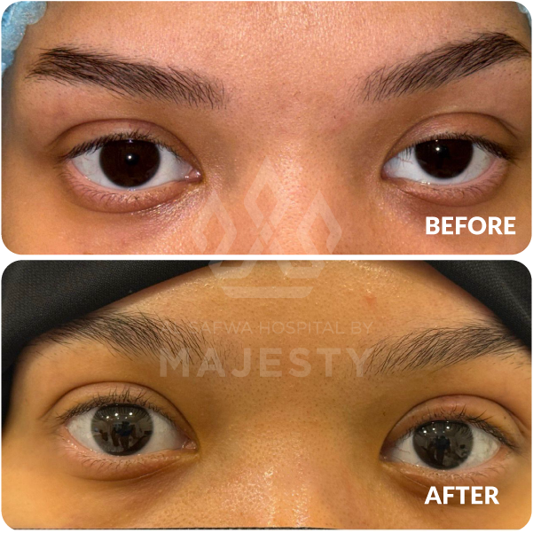 تجميل الجفون