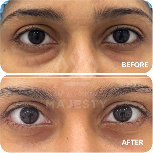 تجميل الجفون